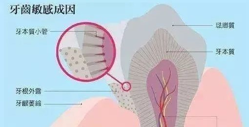 五招拯救牙齿敏感解决冷热酸甜倒牙！