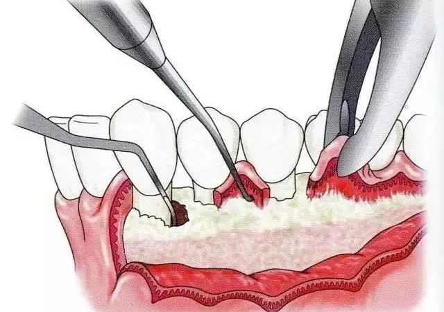 得了牙周炎应该怎么办？