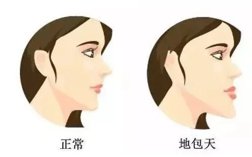 儿童地包天的最佳治疗时间—义乌傅氏口腔