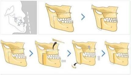 儿童地包天的最佳治疗时间—义乌傅氏口腔
