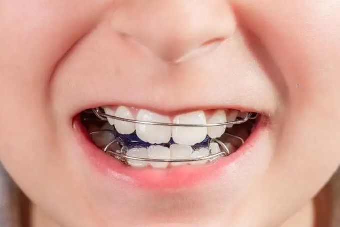 须知儿童牙齿矫正的那些事! 须知儿童牙齿矫正的那些事!