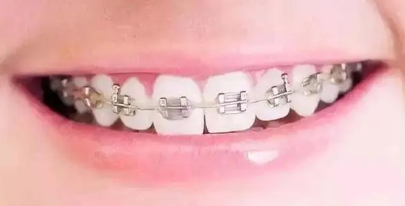 须知儿童牙齿矫正的那些事! 须知儿童牙齿矫正的那些事!