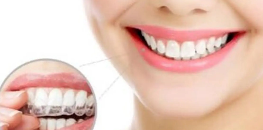 你定会想知道，牙齿矫正后会反弹吗？—义乌傅氏口腔