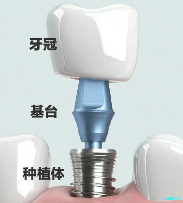 缺牙有哪些常见的补牙方式?—义乌牙齿修复 缺牙有哪些常见的补牙方式?—义乌牙齿修复