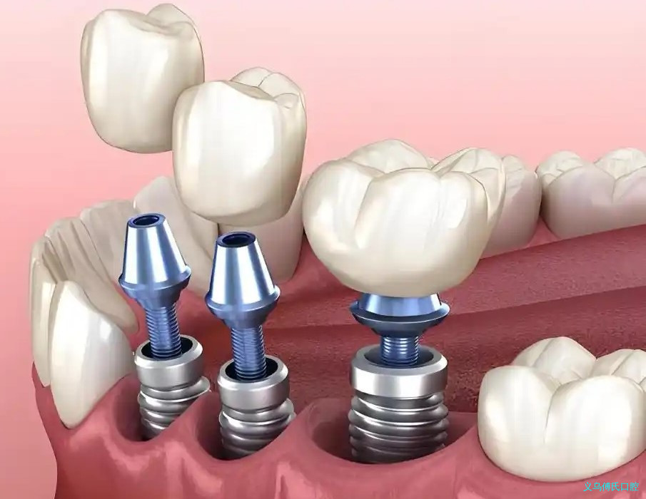 缺牙有哪些常见的补牙方式?—义乌牙齿修复 缺牙有哪些常见的补牙方式?—义乌牙齿修复