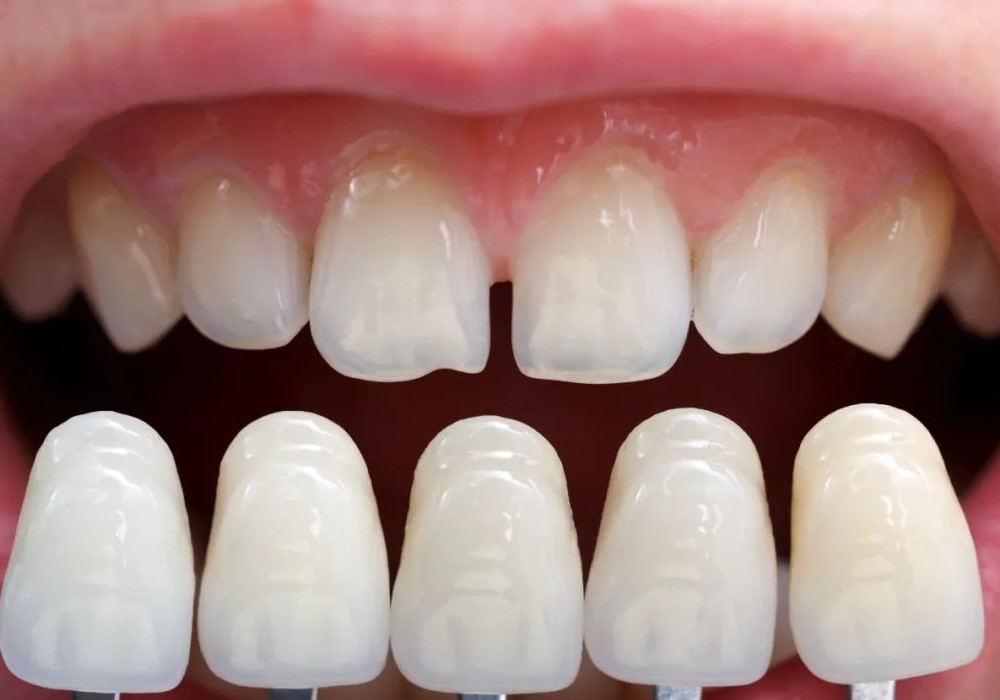 牙缝过大的处理方法和注意事项！