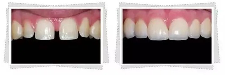 牙缝过大的处理方法和注意事项！