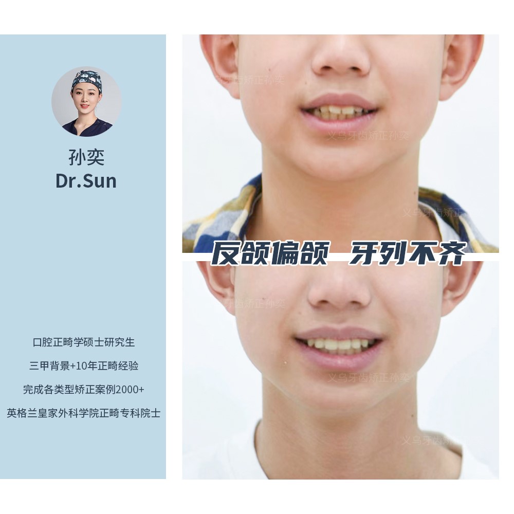 义乌傅氏口腔反颌偏颌牙列不齐矫正案例分享! 义乌傅氏口腔反颌偏颌牙列不齐矫正案例分享!