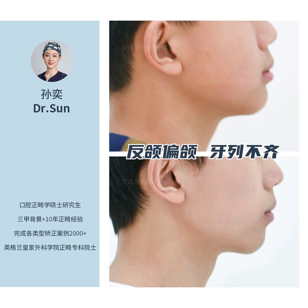 义乌傅氏口腔反颌偏颌牙列不齐矫正案例分享! 义乌傅氏口腔反颌偏颌牙列不齐矫正案例分享!
