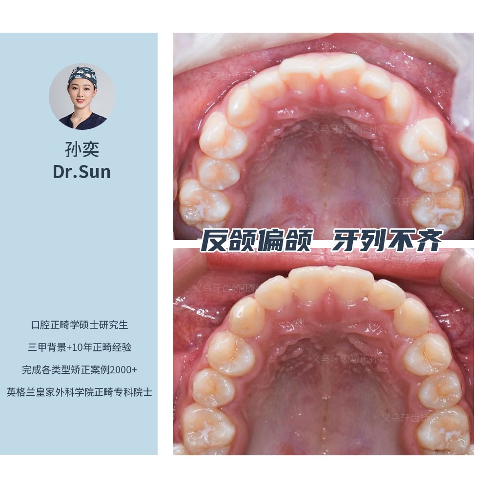 义乌傅氏口腔反颌偏颌牙列不齐矫正案例分享! 义乌傅氏口腔反颌偏颌牙列不齐矫正案例分享!