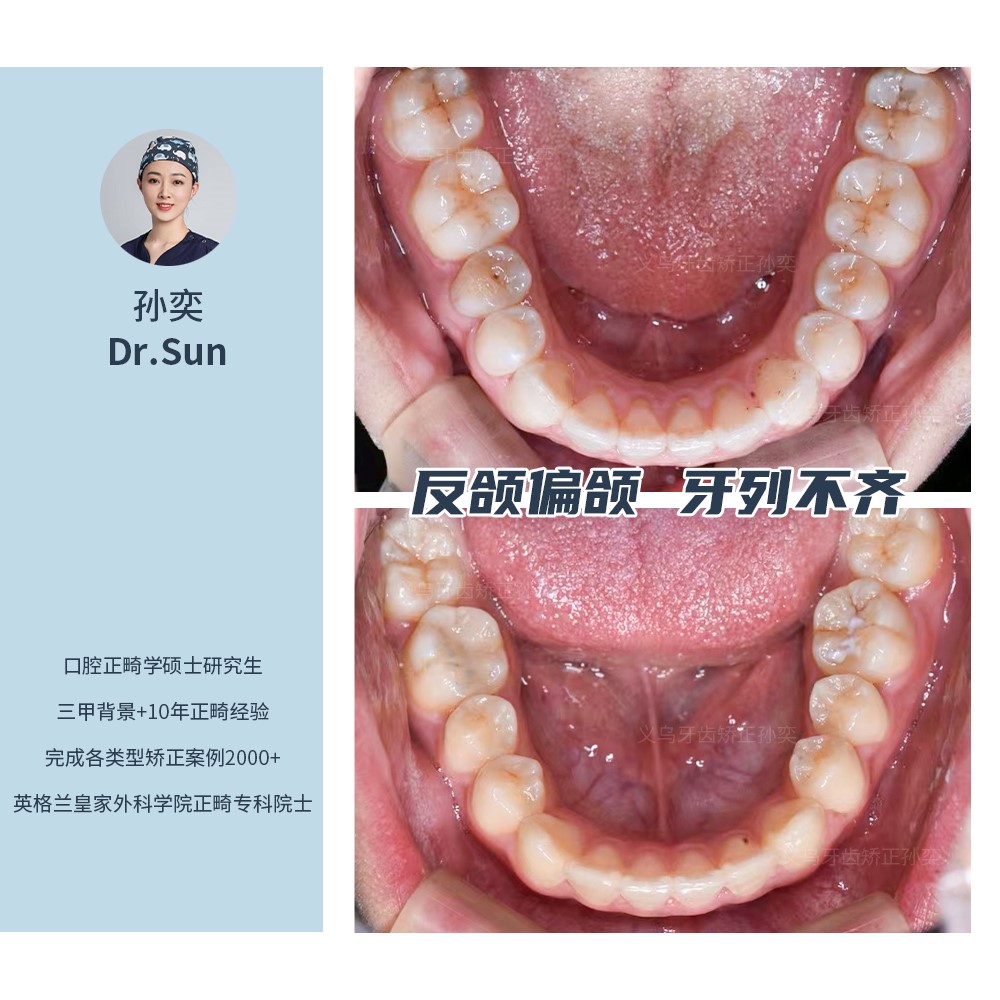 义乌傅氏口腔反颌偏颌牙列不齐矫正案例分享! 义乌傅氏口腔反颌偏颌牙列不齐矫正案例分享!