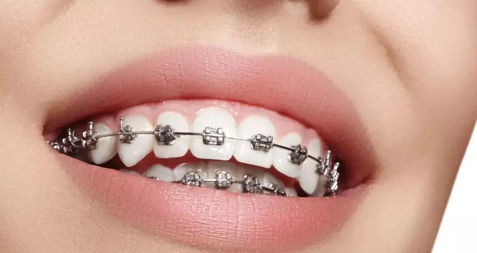 牙齿矫正后，按时复诊的重要性你知道吗？