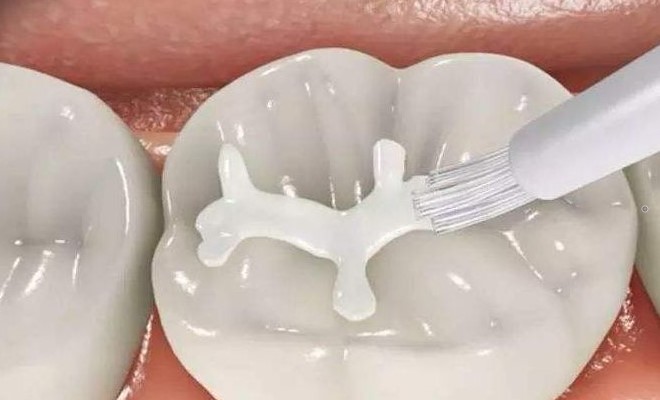 牙齿缺失,补牙后会有哪些不适?—义乌傅氏口腔 牙齿缺失,补牙后会有哪些不适?—义乌傅氏口腔