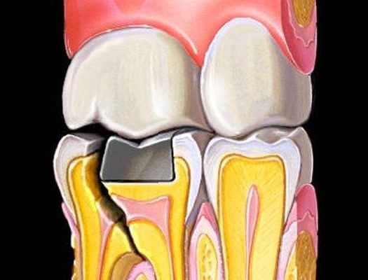 牙齿缺失,补牙后会有哪些不适?—义乌傅氏口腔 牙齿缺失,补牙后会有哪些不适?—义乌傅氏口腔