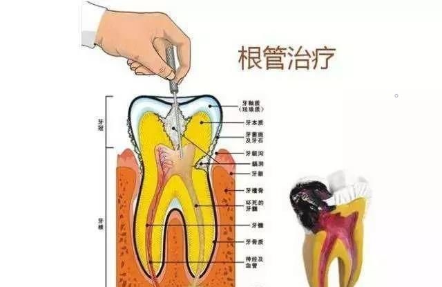 根管治疗，医生的钻头磨掉了什么？—义乌傅氏口腔