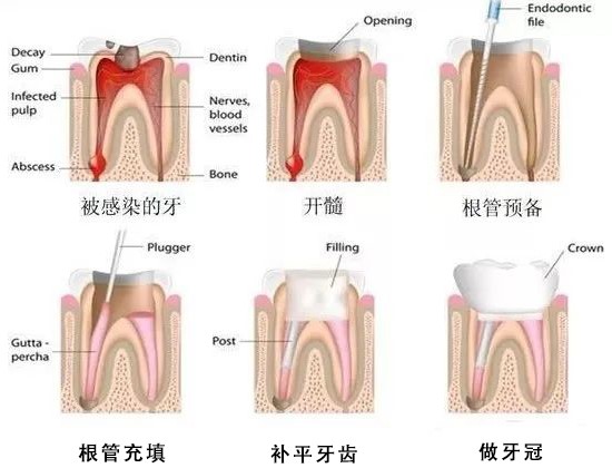根管治疗，医生的钻头磨掉了什么？—义乌傅氏口腔
