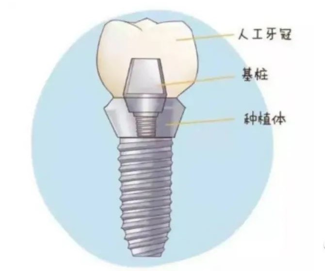 想种个牙,为何还得治疗牙周病? 想种个牙,为何还得治疗牙周病?