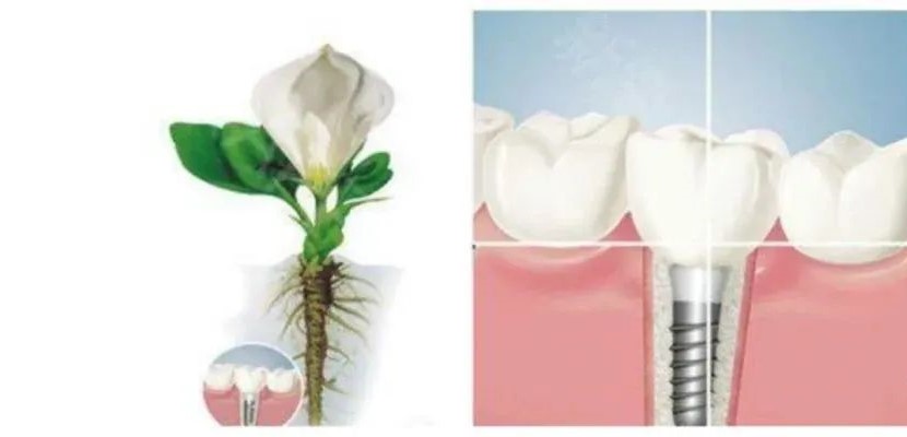 想种个牙,为何还得治疗牙周病? 想种个牙,为何还得治疗牙周病?