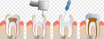 根管封药多次还疼的处理办法! 根管封药多次还疼的处理办法!