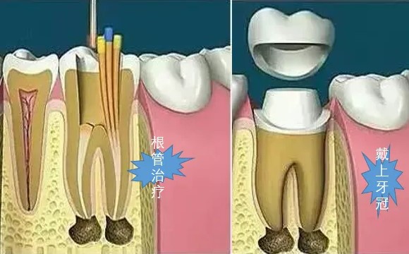 根管封药多次还疼的处理办法! 根管封药多次还疼的处理办法!