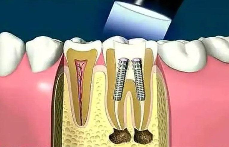 根管封药多次还疼的处理办法! 根管封药多次还疼的处理办法!