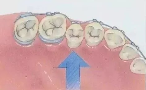 正畸弓丝的临床选择! 正畸弓丝的临床选择!