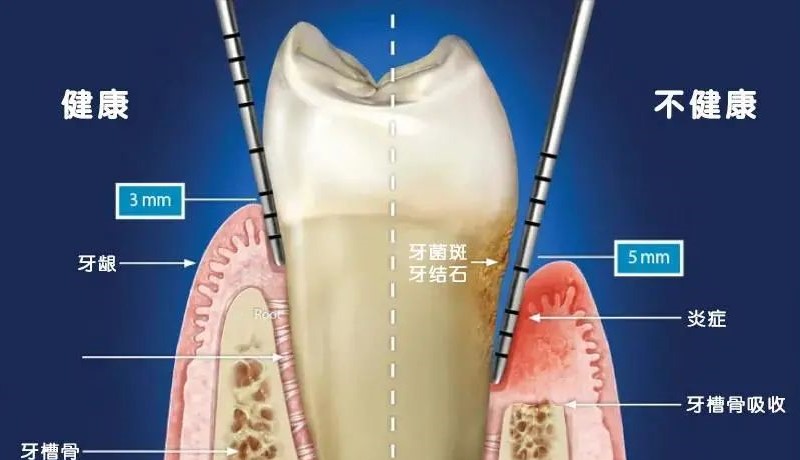 龈下刮治并不是暴力的把牙龈掀开！