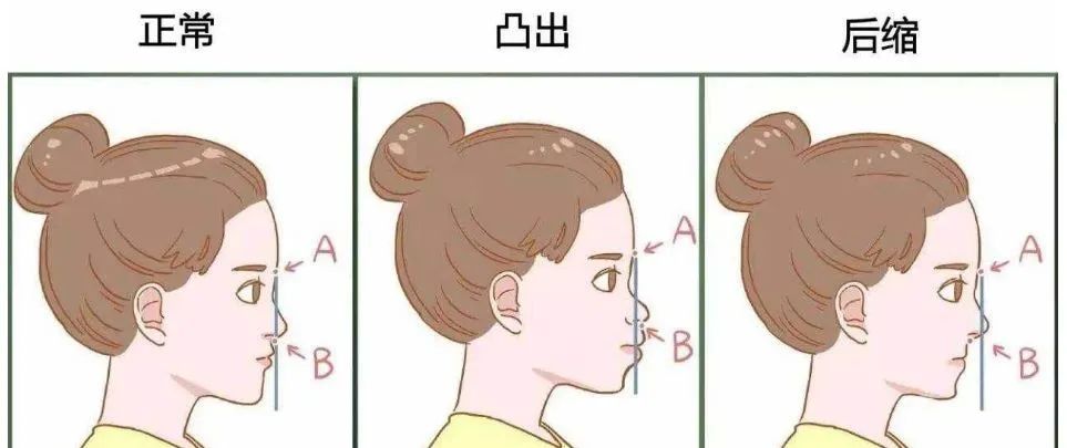 儿童时的瓜子脸,小心变成大龅牙!—义乌傅氏口腔 儿童时的瓜子脸,小心变成大龅牙!—义乌傅氏口腔