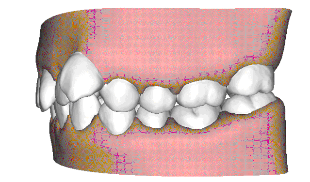 儿童时的瓜子脸,小心变成大龅牙!—义乌傅氏口腔 儿童时的瓜子脸,小心变成大龅牙!—义乌傅氏口腔