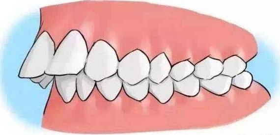 正畸医生让打骨钉不用怕，这是矫正利器！