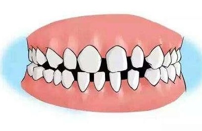 正畸医生让打骨钉不用怕，这是矫正利器！