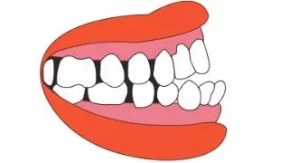 正畸医生让打骨钉不用怕，这是矫正利器！