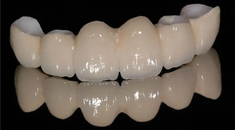 为何选择贵的全瓷牙也不选择烤瓷牙？