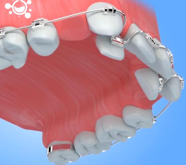 古人矫正牙齿太奇葩,原来竟然可以这样!—义乌傅氏口腔 古人矫正牙齿太奇葩,原来竟然可以这样!—义乌傅氏口腔