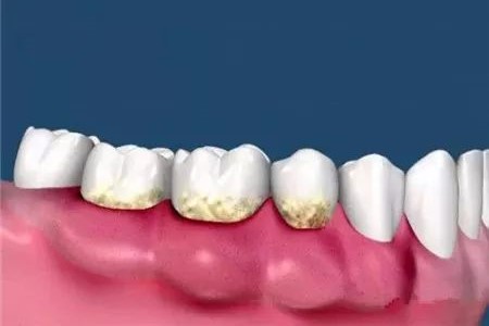 不洗牙,小心牙周炎吃掉你的骨头! 不洗牙,小心牙周炎吃掉你的骨头!