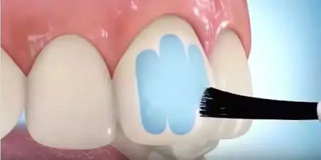 箍牙全过程，牙套是这样戴上去的！—义乌傅氏口腔