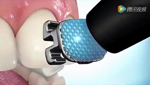 箍牙全过程，牙套是这样戴上去的！—义乌傅氏口腔