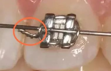 箍牙全过程，牙套是这样戴上去的！—义乌傅氏口腔