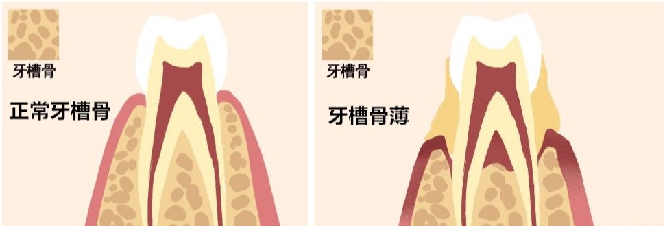 骨量不足能种牙吗? 骨量不足能种牙吗?