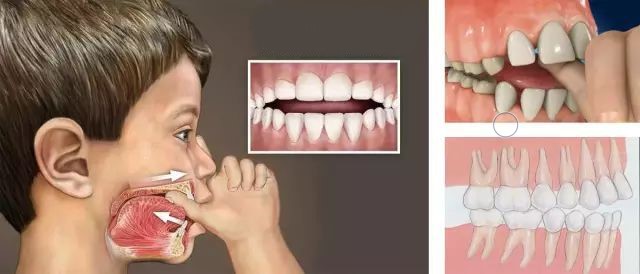 关于孩子牙齿不齐的解读—义乌傅氏口腔