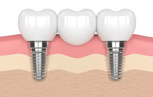 种植牙好在哪里？能用多久？