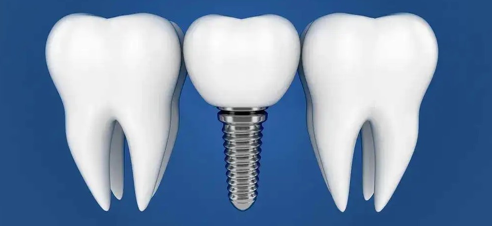 种植牙好在哪里？能用多久？