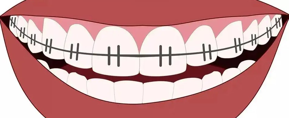 很好奇，牙齿矫正后会反弹吗？—义乌傅氏口腔