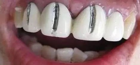 种植牙可以核磁共振吗? 种植牙可以核磁共振吗?