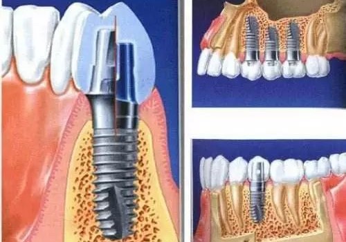 种植牙可以核磁共振吗? 种植牙可以核磁共振吗?