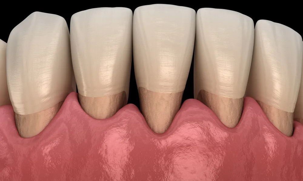 做牙齿矫正，会导致“黑三角”？—义乌傅氏口腔