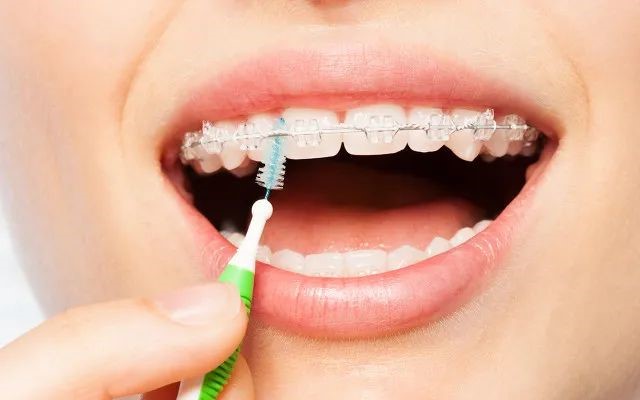 做牙齿矫正，会导致“黑三角”？—义乌傅氏口腔