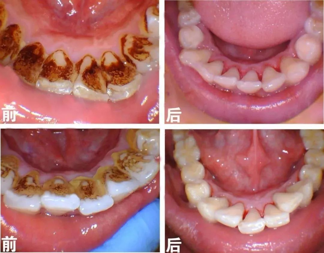 忽视牙齿上的“黑线”,很快就会满牙黑线！—义乌傅氏口腔