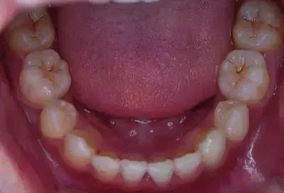 忽视牙齿上的“黑线”,很快就会满牙黑线！—义乌傅氏口腔