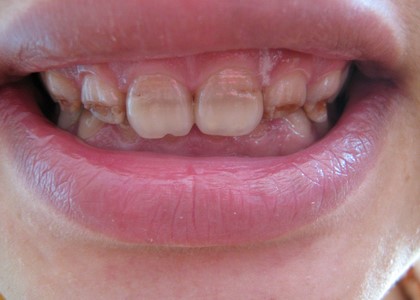 孩子的牙齿为什么会黑？